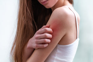 Dermatita (eczema): cauze, simptome, preventie si tratament